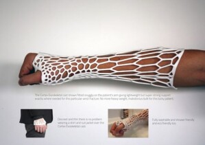 3d_printed_cast
